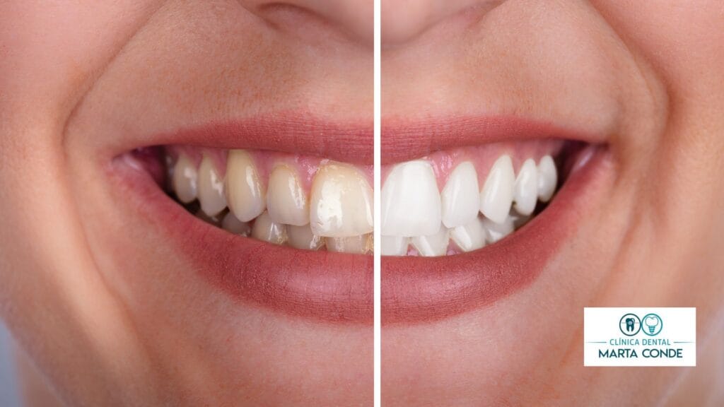 blanqueamiento dental en boadilla del Monte