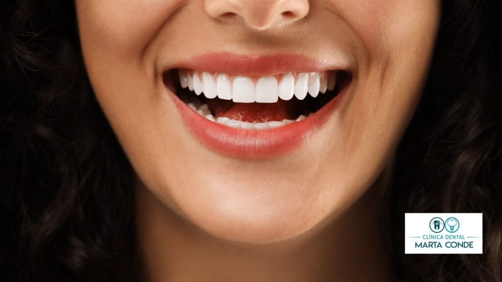 carillas dentales en Boadilla del Monte Madrid