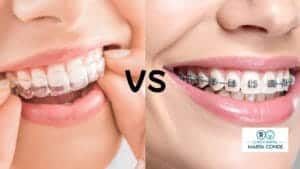 Invisalign vs brackets metálicos, cuál elegir
