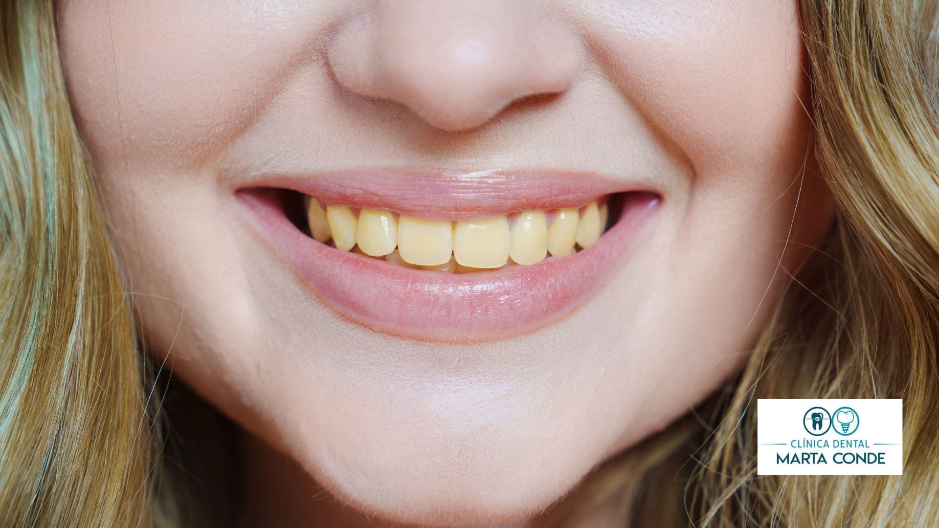 Manchas en los dientes por fumar